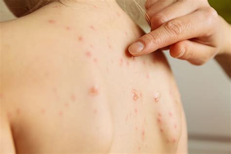 Tips To Prevent Skin Infections Focus On Kids Pediatrics