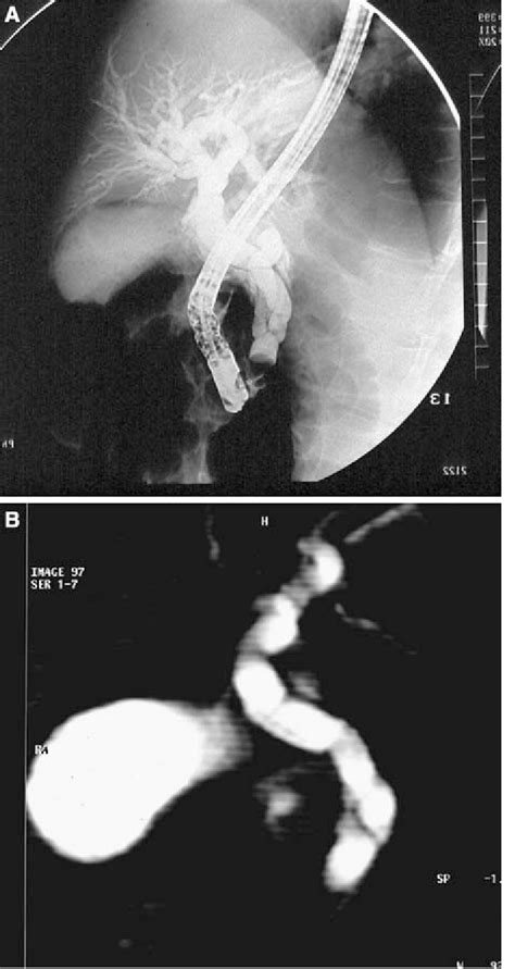 A Endoscopic Retrograde Cholangiopancreatography Ercp Lateral