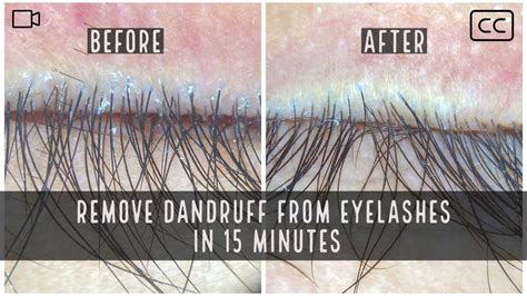 Get rid of dandruff from eyelashes like a dermatologist | #Blepharitis