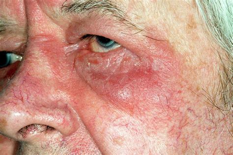 Eczema Around The Eye Photograph By Dr P Marazziscience Photo Library