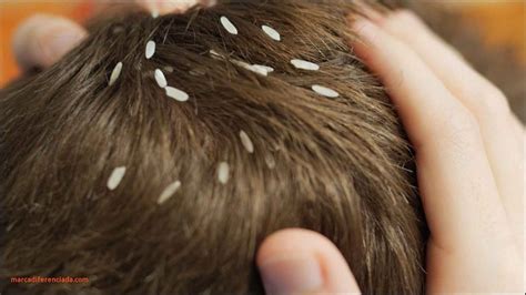 Head Lice Eggs In Hair Caraway Seeds Health Benefits