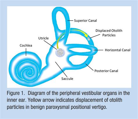 This Is The Most Common Cause Of Vertigo And How We Handle It Bppv