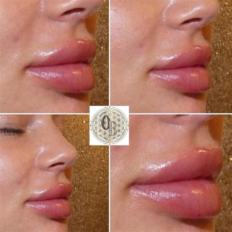Lips Enhancement Side Profile Lip Enhancement Lips Makeup