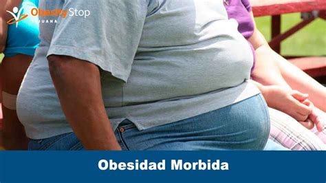 Top 183 Imagenes De La Obesidad Morbida Destinomexicomx