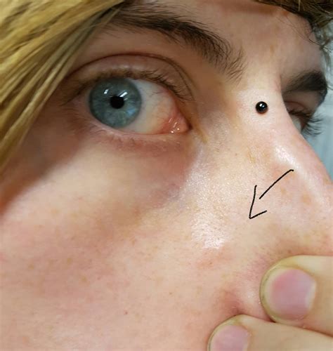 Acne Solid Painless Lump Under Skin Which Was Formerly A Blind