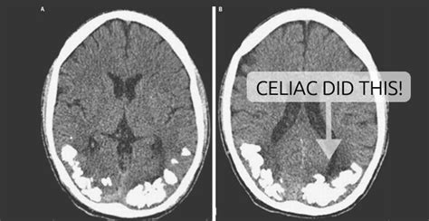 Celiac Disease When Your Brain Cant Breathe