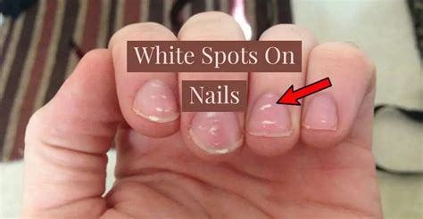 The Best White Spots On Nails Vitamin Deficiency Reddit References