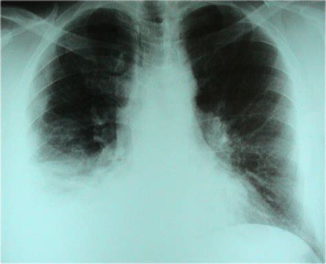 Chest X Ray Ap Right Lung Base Consolidation Download Scientific