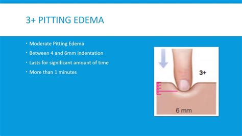 Pitting Edema Levels