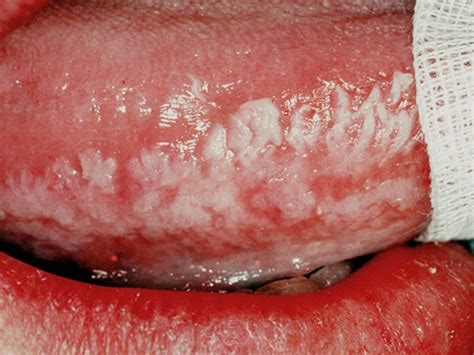 Leukoplakia Oral Keratosis Oral