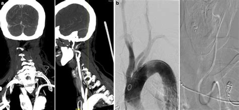 A Type 3 Aorta In Coronal And Sagittal Views Of Ct Angiogram B Type