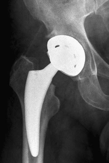 Vii Current Developments In Short Stem Femoral Implants For Hip