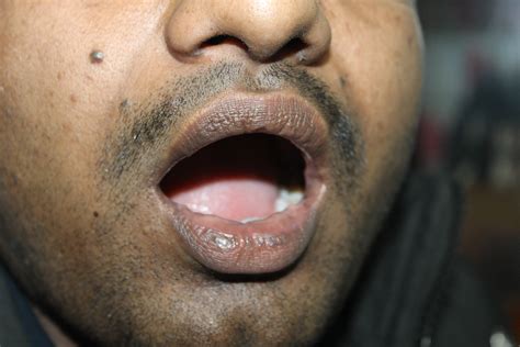 How To Identify Vitiligo On Lips