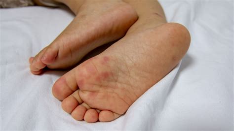 Hand Foot And Mouth Disease Hfmd Why Your Child Is At Risk Whitecoat