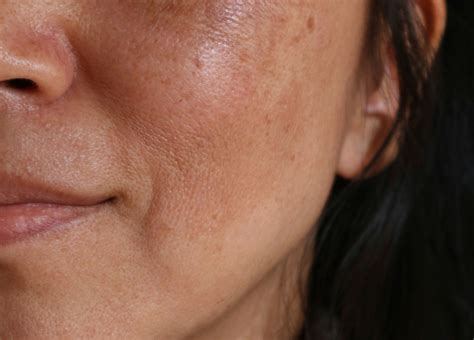 What Can You Do About Dark Spots On Your Skin Marlo Hydroponic Skincare