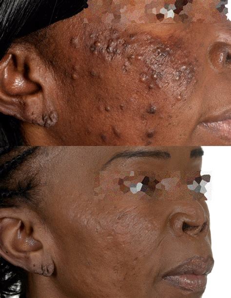 What Causes Acne And How Should This Be Treated