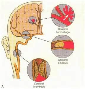 Search for text in url. Doctor Man's Blog: 中風(Stroke)