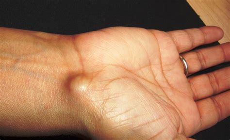 Ganglion Cyst Wikipedia The Exact Cause Of The Formation Flickr