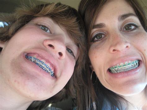 And Then Theres Us Sillies Modeling Our Braces Just Got Flickr