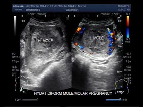 Complete Hydatidiform Mole Also Called Molar Pregnancy Youtube
