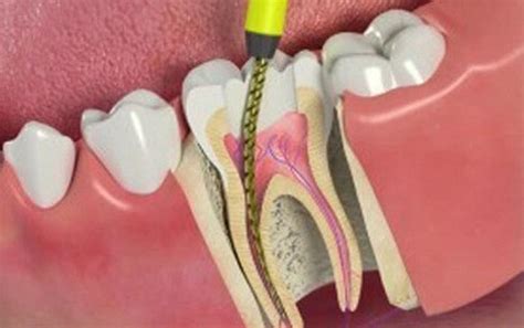 Co To Jest Endodoncja Na Czym Polega Jak D Vgo Trwa I Ile Kosztuje My