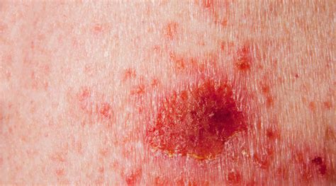 Signs Of Late Stage Skin Cancer