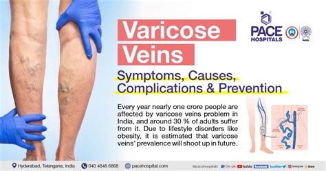 Varicose Veins Causes Symptoms And Effective Treatment Options