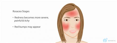 Rosacea Symptoms Early Signs And Full Blown Symptoms