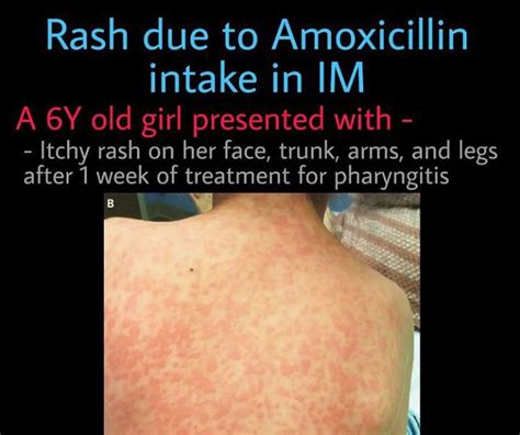 Rash Due To Amoxicillin Intake Medizzy