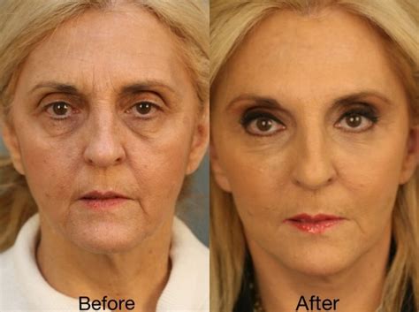 The Beverly Hills Facelift™ Elevates Facial Rejuvenation Using Natural