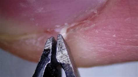 Hangnail Removal Under The Microscope Youtube