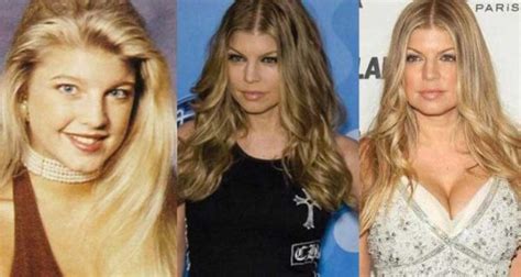 Fergie Plastic Surgery Before And After Pictures 2024