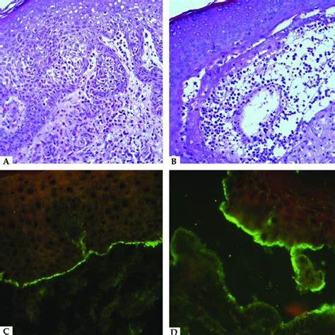 Classic Bullous Pemphigoid Tense Blisters With Hemorrhagic A And