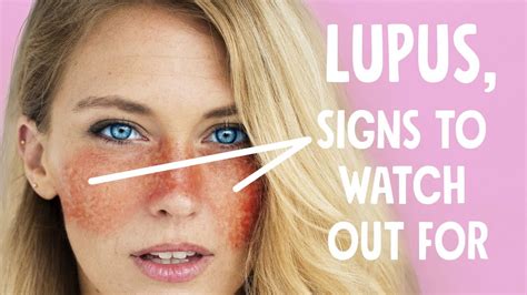 10 Warning Signs Of Lupus To Watch Out For YouTube