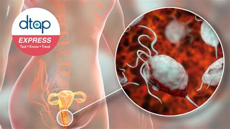 Trichomoniasis In Women Std Testing Clinic Dtap Express