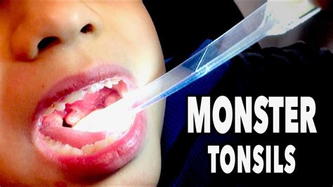 Monster Tonsils Abscess Tonsillitis Dr Paul Youtube