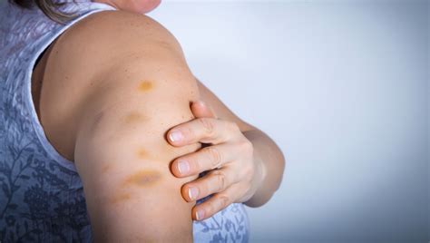 How To Stop Most Bruises From Insulin Injections Type 2 Nation