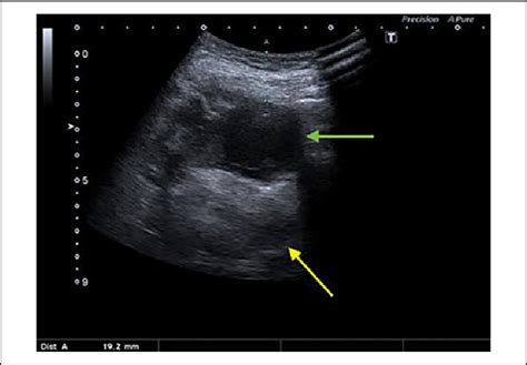Submandibular Abscess Ultrasound