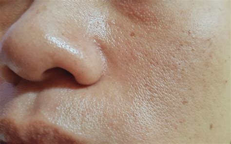 How To Treat Clogged Pores At Home The Aedition