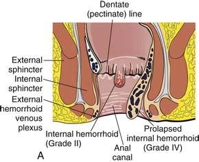 For symptomatic relief, and there. Office Treatment of Hemorrhoids | Basicmedical Key