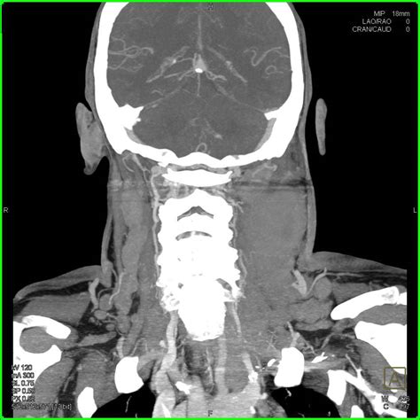 Lymphoma With Massive Neck Adenopathy Neuro Case Studies Ctisus Ct