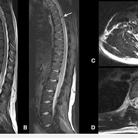 Sagittal T2 Weighted MRI Scans Of The Thoracic Spine A B And Axial