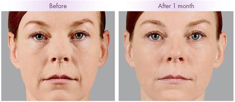 Voluma Nonsurgical Injectables Top 1 Filler Injector Bryn Mawr Pa