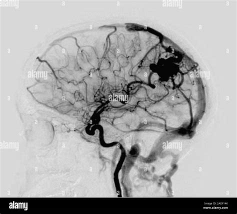 Cerebral Arteriovenous Malformation Lateral X Ray Of The Skull And