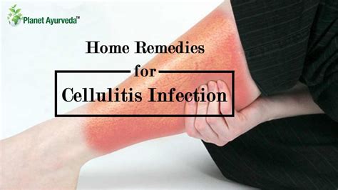 Home Remedies For Cellulitis Infection