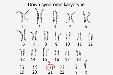 Down Syndrome Chromosome Chart