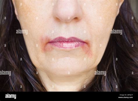 Perleche Or Perioral Dermatitis Womans Mouth With Big Red Spots Of