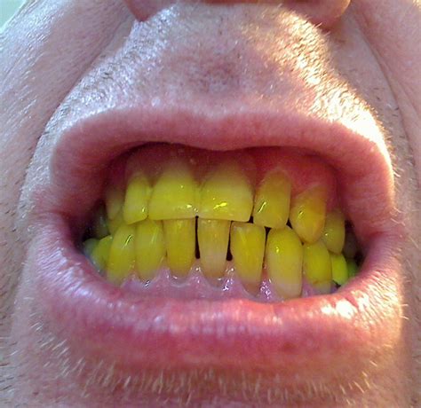 My Yellow Teeth Free Stock Photo - Public Domain Pictures