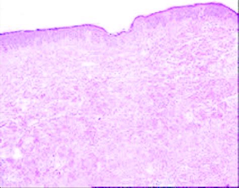 Morphea Pathology Image Hex100 Coarsening And Flattening In The