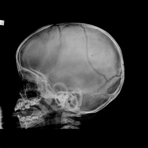 Skull Fractures Image